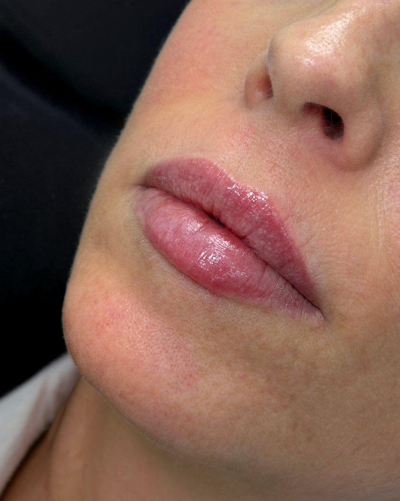 Lip fillers na de behandeling bij House of Bratz
