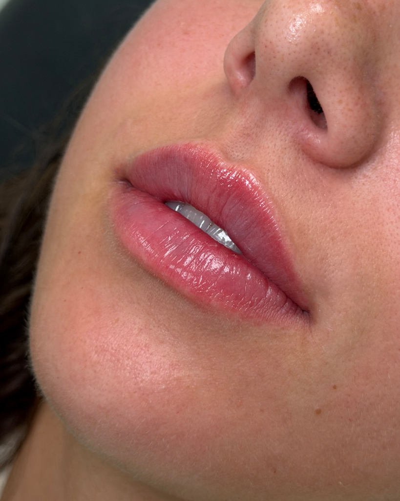 Lip fillers na de behandeling bij House of Bratz