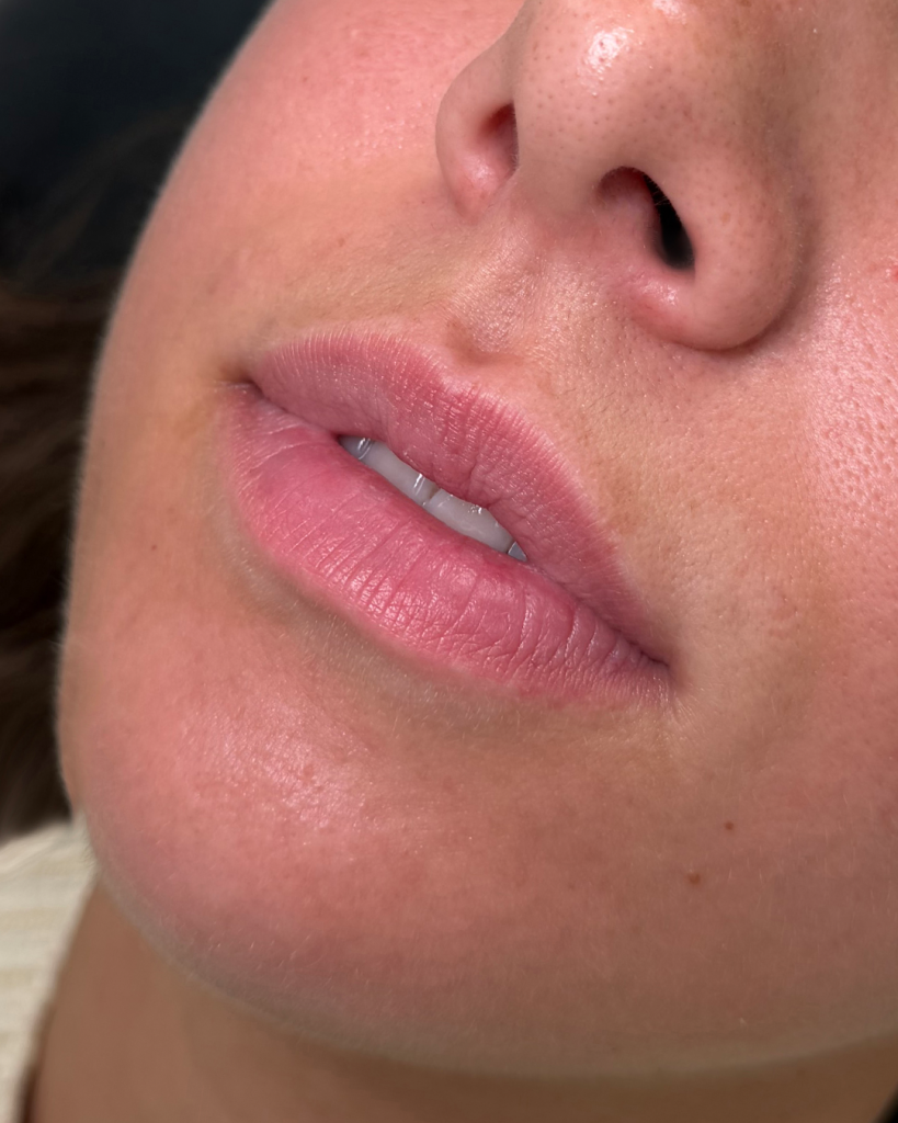 Lip fillers voor de behandeling bij House of Bratz