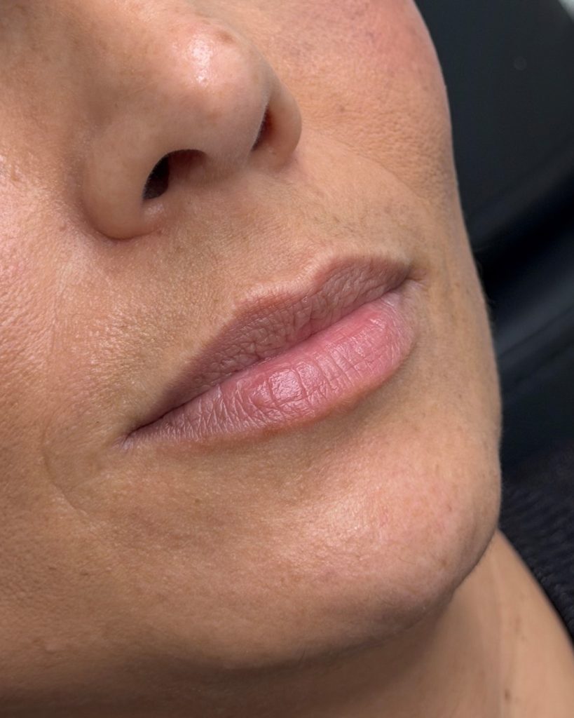 Lip fillers voor de behandeling - House of Bratz