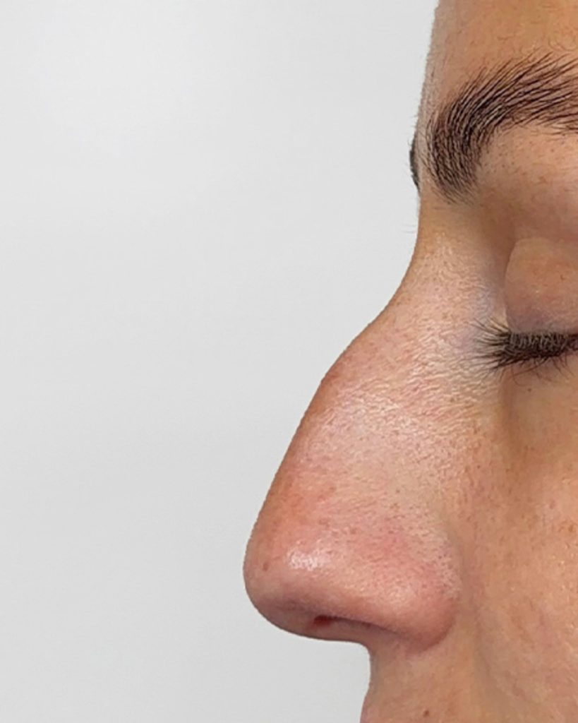 Neuscorrectie met filler voor de behandeling bij House of Bratz